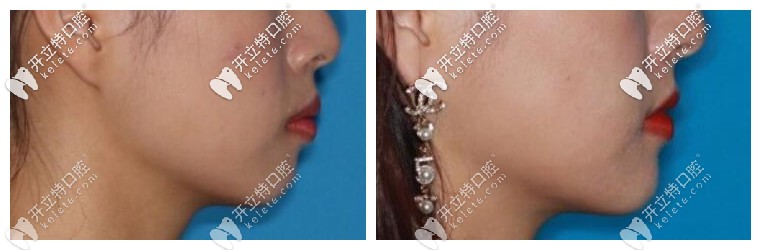 舌側隱形牙套矯正前后對比照