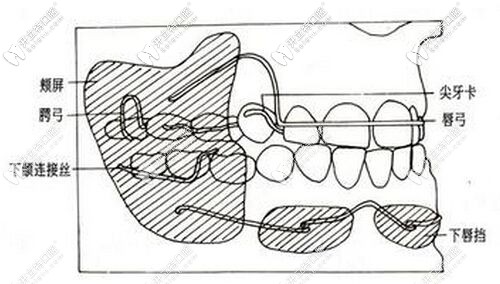 活動(dòng)矯正器結(jié)構(gòu)圖 活動(dòng)矯正器結(jié)構(gòu)圖