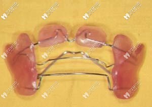功能性矯正器的外觀 功能性矯正器的外觀