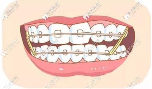 傳統(tǒng)的鋼絲矯正 傳統(tǒng)的鋼絲矯正