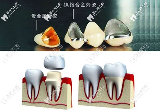 烤瓷牙的材質(zhì)和結(jié)構(gòu)圖