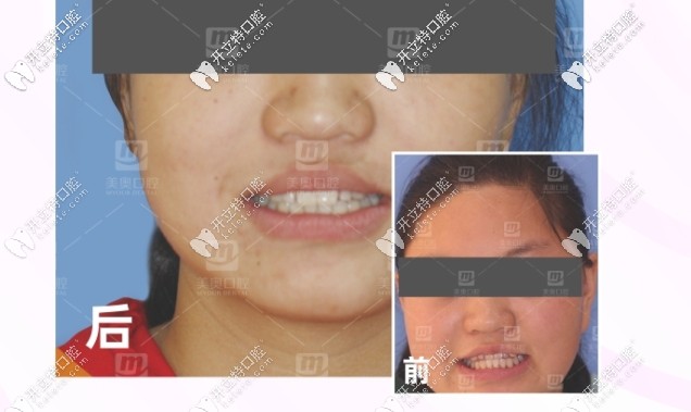 地包天矯正前后對(duì)比圖