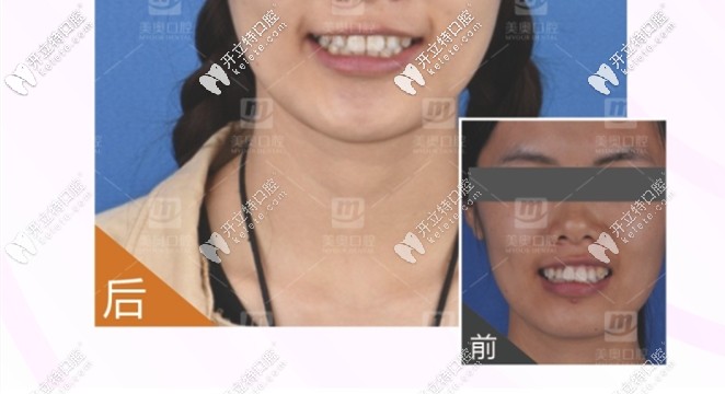 齙牙矯正牙齒前后對(duì)比圖
