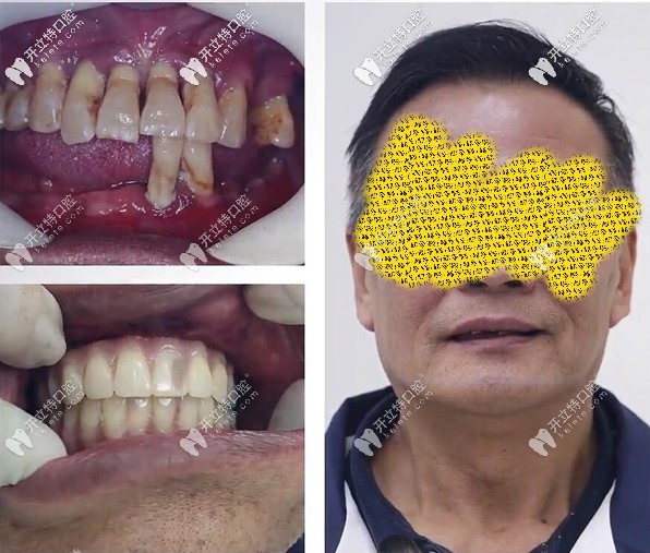 廣州柏德牙科我做全口allon6即刻種植牙用了1小時,過程和種牙價格我得嘮嘮