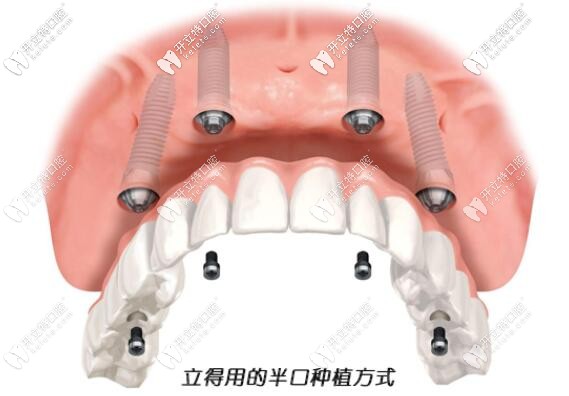 立得用半口種植牙
