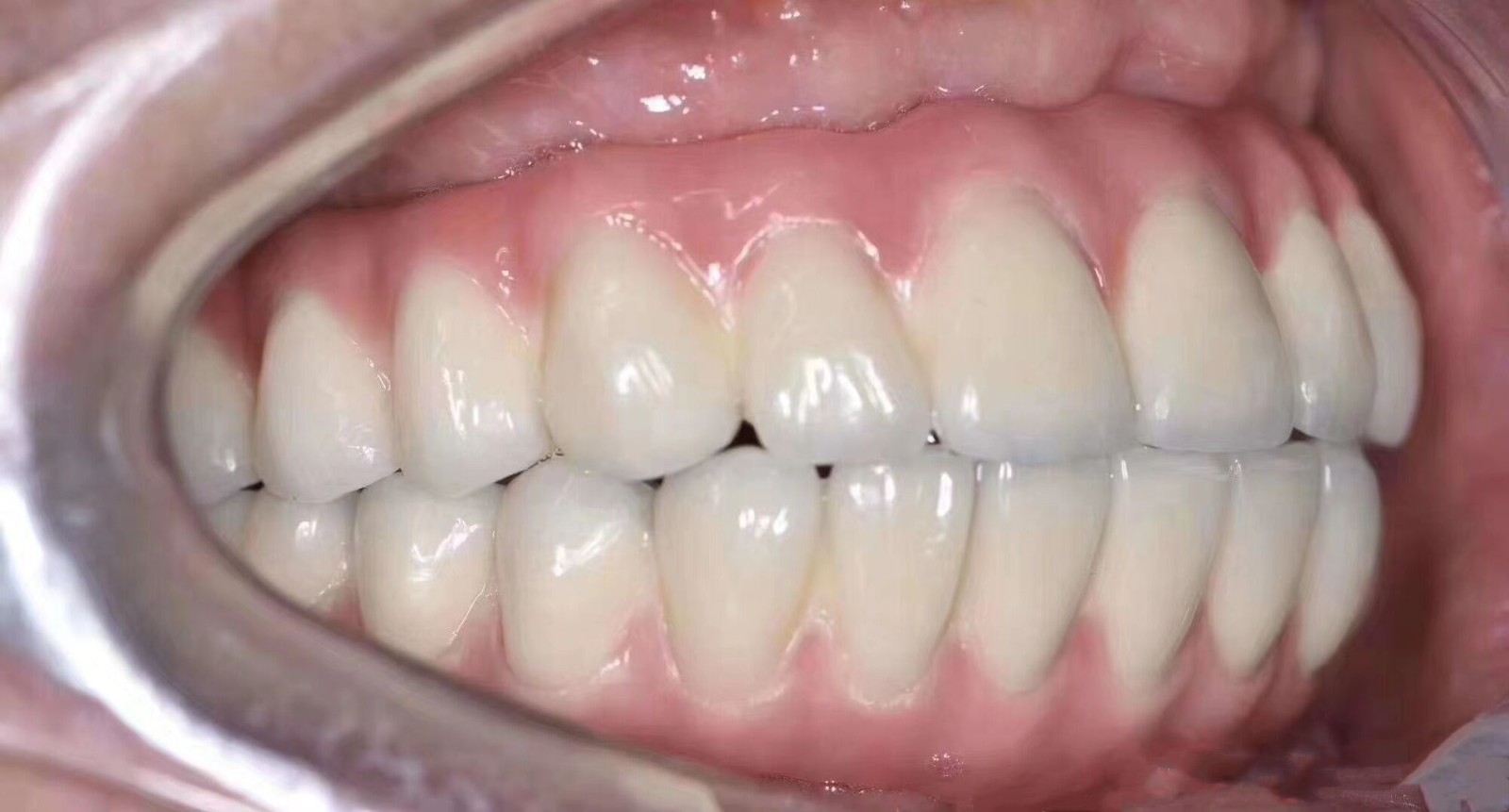 牙周病滿(mǎn)口沒(méi)牙不想活了?沈陽(yáng)的全口即刻種植牙3h恢復(fù)咀嚼