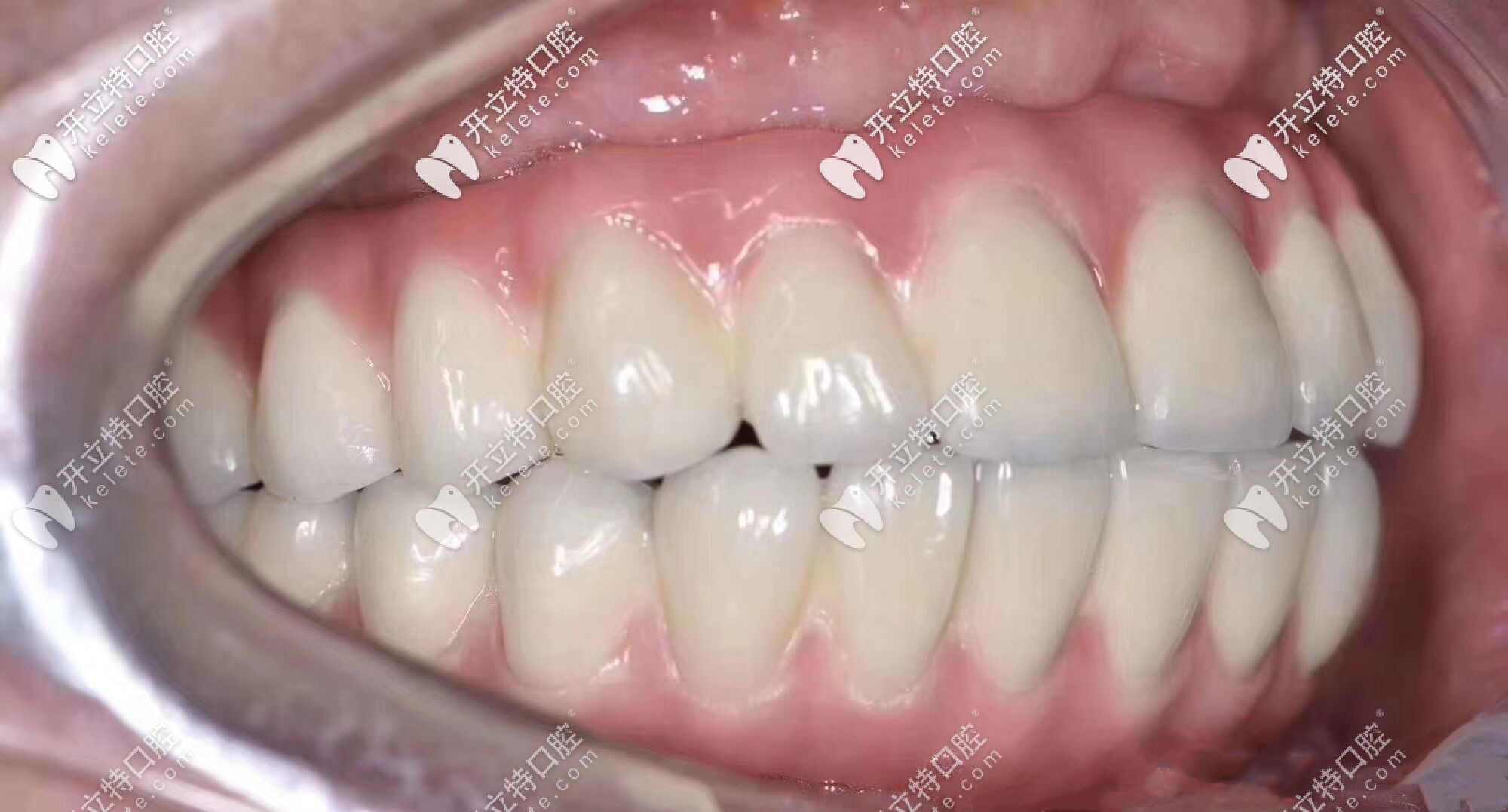 全口即刻種植牙后圖示
