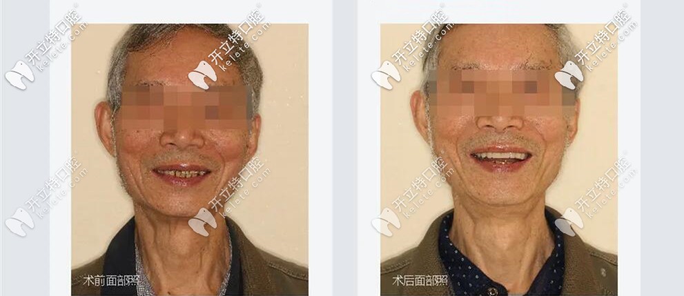 微創(chuàng)種植牙治療前后對(duì)比圖