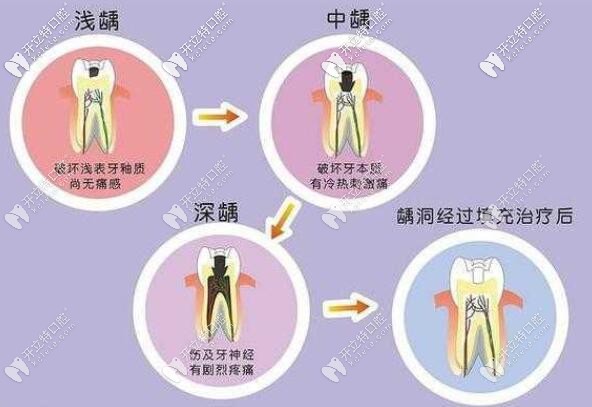 齲齒的發(fā)展過程