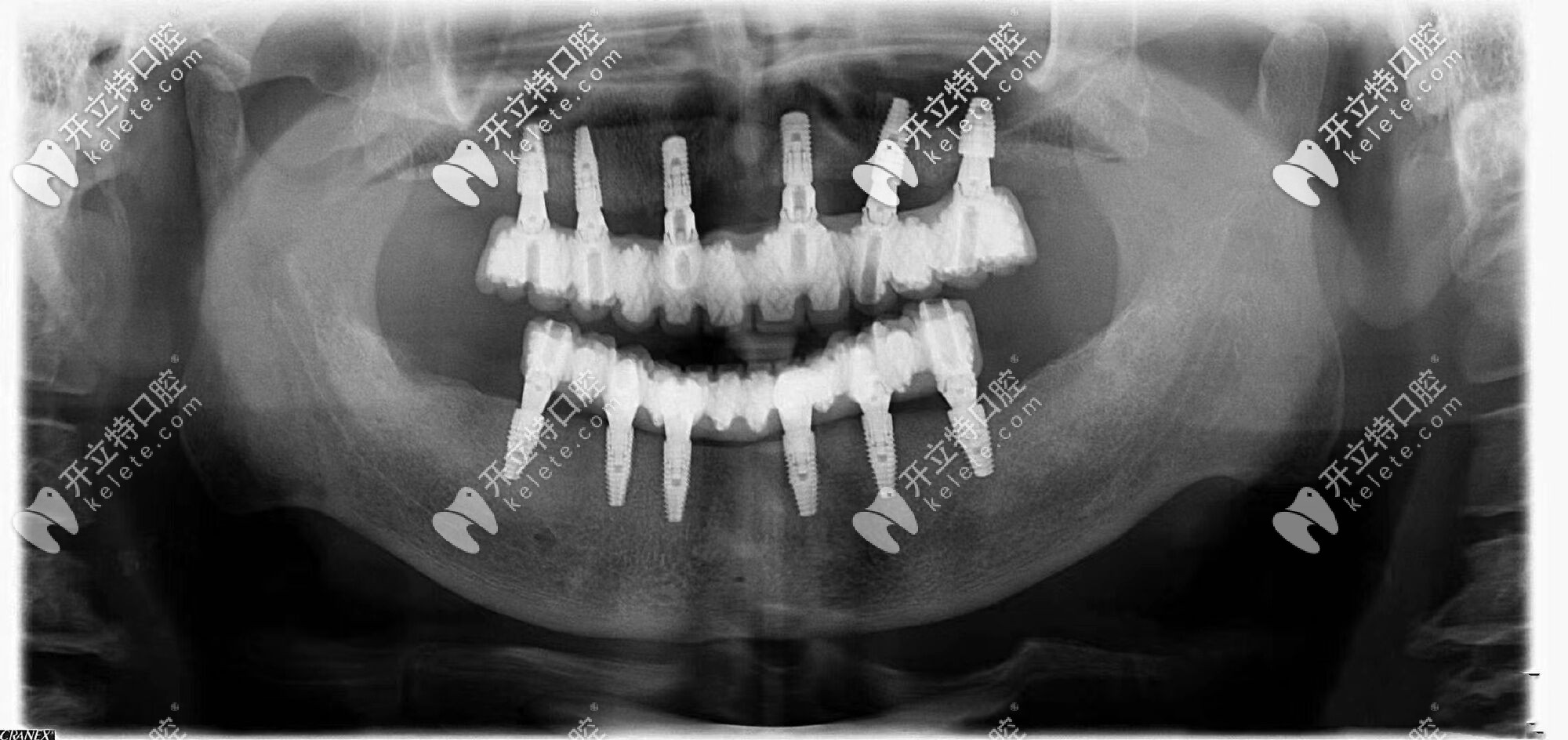 口內(nèi)拍片圖示