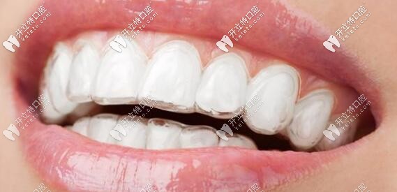 隱形牙齒矯正