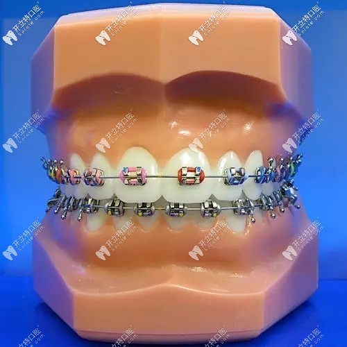金屬牙套的外觀