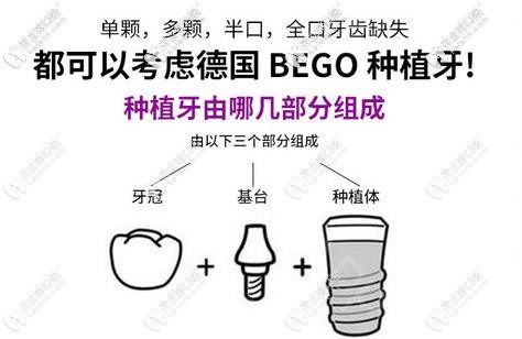 德國Bego種植體