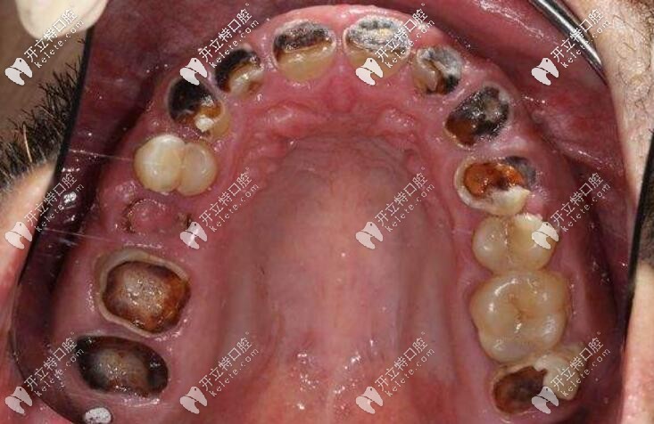 19歲牙齒全壞了怎么辦