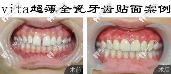 德國vita瓷貼面的效果怎么樣