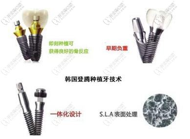 登騰種植體的設(shè)計