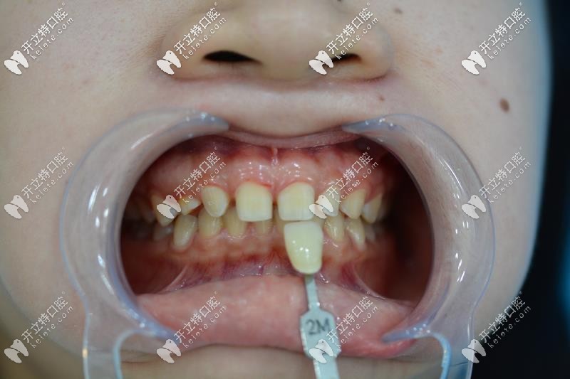 牙齒貼面比色，<!--<i data=20240703-sp></i>-->口腔