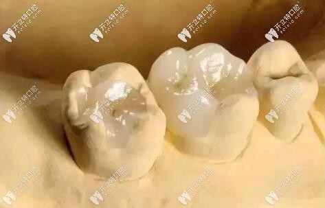 嵌體補牙
