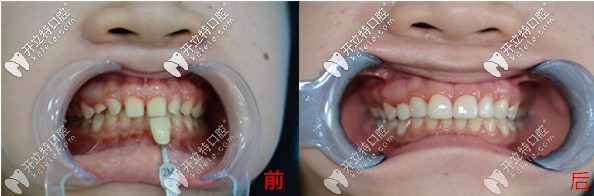 武漢仁愛口腔武漢小姐姐分享超薄美加瓷貼面修復(fù)門牙縫隙的效果及價格