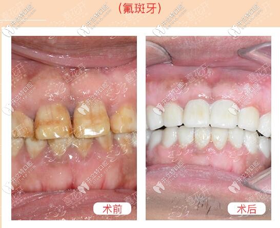 武漢仁愛口腔武漢小伙氟斑牙做義獲嘉超薄瓷貼面美白經(jīng)歷,在乎價格的進