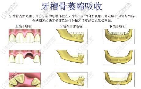 能否做種植牙的基礎(chǔ)條件 能否做種植牙的基礎(chǔ)條件