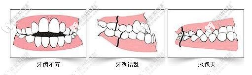 錯頜畸形的幾種癥狀