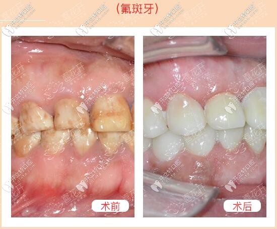 <!--<i data=20240703-sp></i>-->口腔醫(yī)院氟斑牙義獲嘉瓷貼面真人案例