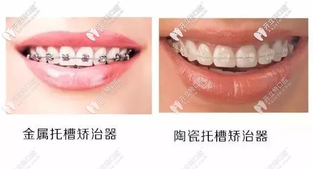 金屬矯正和陶瓷托槽矯正