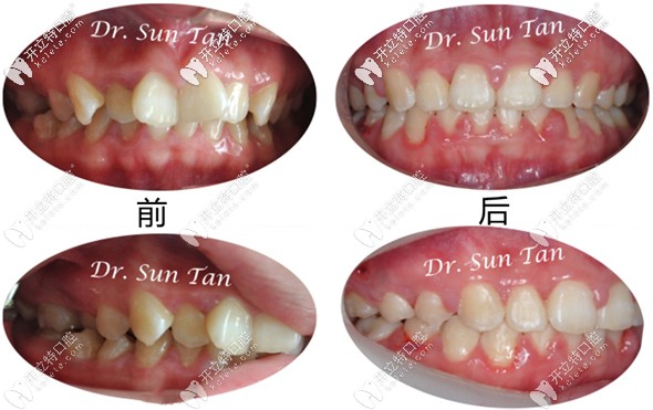 據(jù)說insignia正畸價格和隱適美差不多？