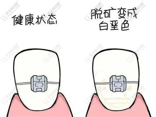 正畸后牙齒脫礦甭擔心,618價格劃算的牙齒冷光美白就能搞定