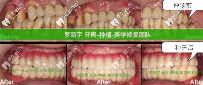 無(wú)錫美奧口腔重度牙周炎患者種牙前后對(duì)比照片
