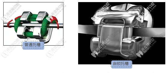 傳統(tǒng)托槽和自鎖托槽