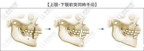 正頜手術(shù)圖解