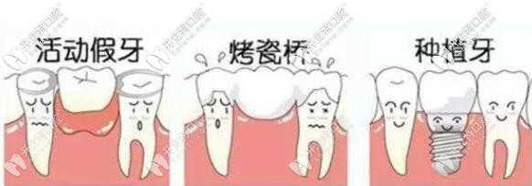 缺牙三種修復(fù)方式比較