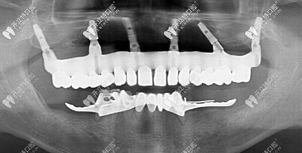 福州維樂(lè)ALL-ON-6上半口即刻種植牙后的CT片