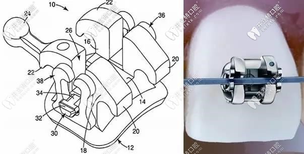 你曉得美國自鎖托槽品牌中的招牌-奧美科ormco與3m哪個貴嗎?