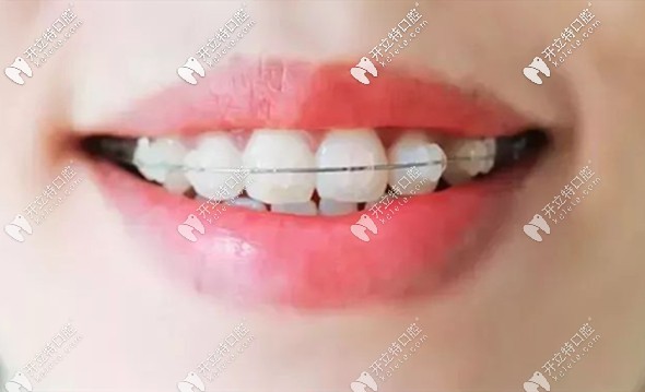 奧美科與3m托槽在矯正效果上哪個(gè)更好