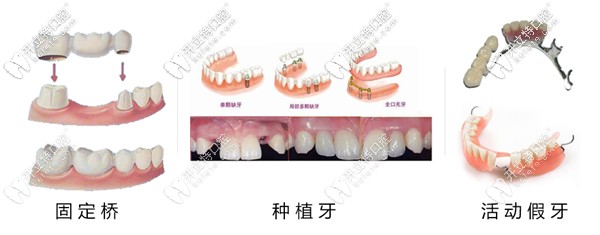 活動(dòng)假牙和種植牙區(qū)別