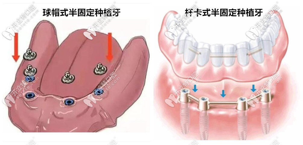 球帽式全口半固定種植牙和卡干式樣