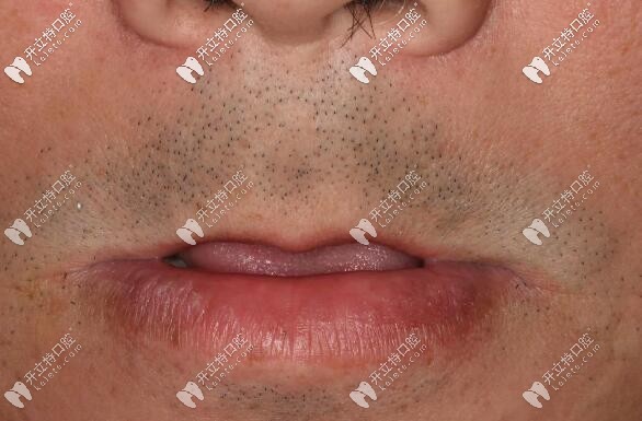 allon6上半口即刻種植牙案例,用的是瑞典諾貝爾pcc種植體