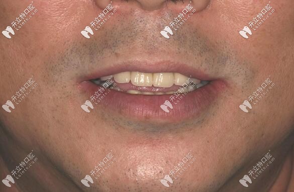 福州維樂(lè)口腔半口種植牙案例