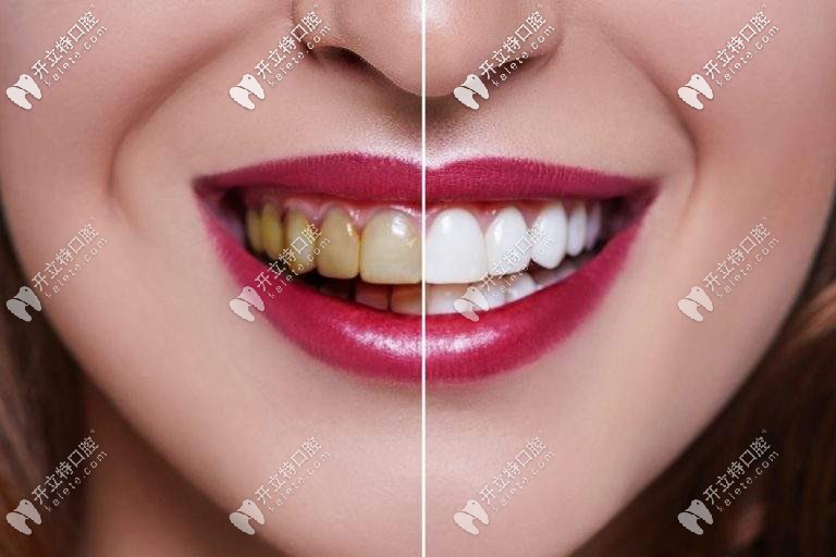 實(shí)錘|在沈陽做牙齒貼面5年沒后悔,快看這瓷貼面圖片和過程