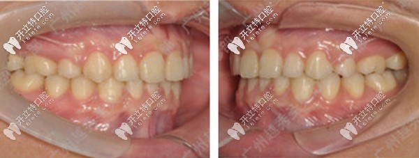 將自己的齙牙交付給廣州越秀區(qū)圣貝牙科的熊飛醫(yī)生 將自己的齙牙交付給廣州越秀區(qū)圣貝牙科的熊飛醫(yī)生