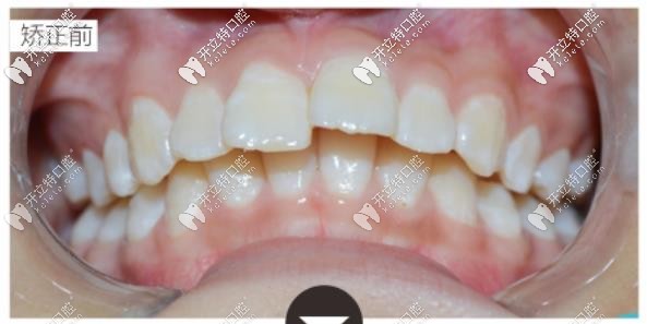 做矯正前的牙齒外觀