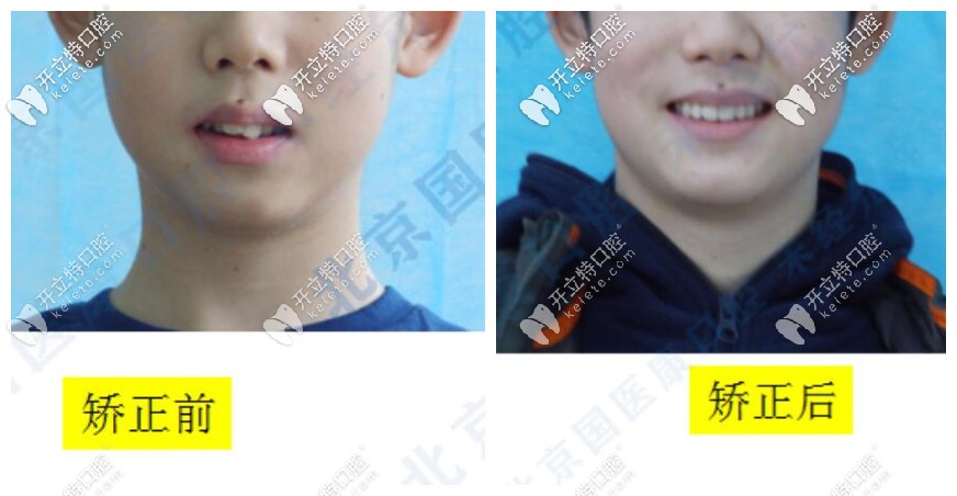兒子深覆合+深覆蓋矯正前后臉型對(duì)比圖