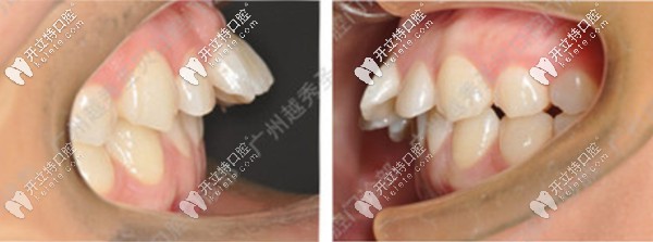 小哥哥在廣州越秀區(qū)整牙前的牙齒照 小哥哥在廣州越秀區(qū)整牙前的牙齒照