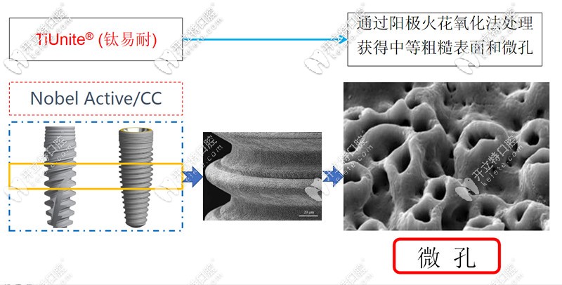 諾貝爾種植體采用鈦易耐表面處理