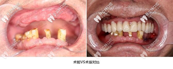上半口allon6種植牙圖片
