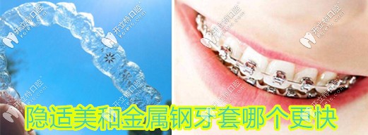 優(yōu)劣大比較,想要快速矯正速來了解隱適美快還是金屬鋼牙快