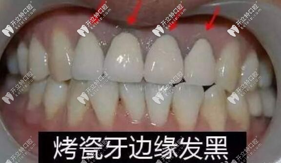 烤瓷牙牙齦發(fā)黑
